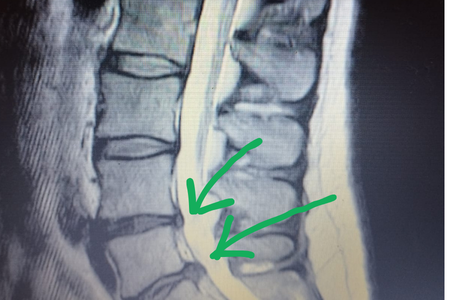 Belde fıtık oluşumu MR görüntüleme