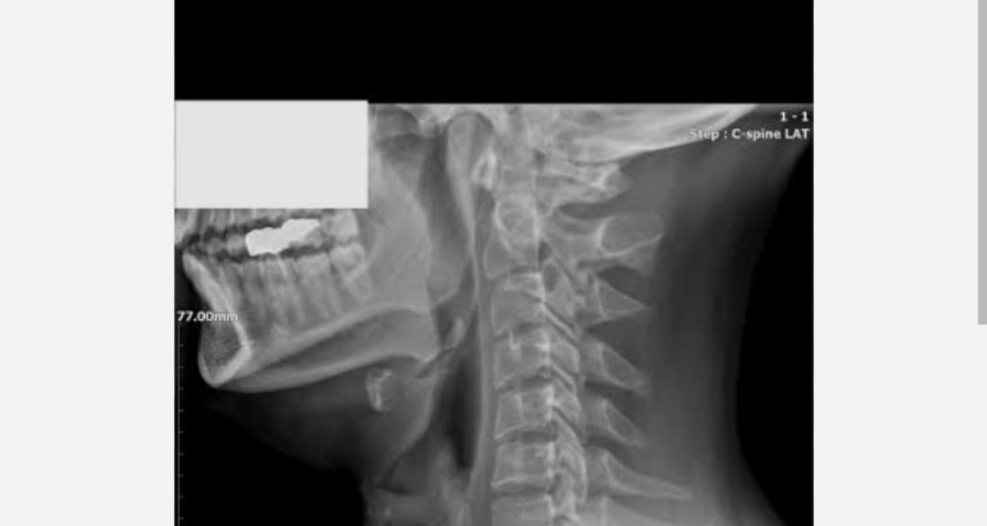 Boyun düzleşmesi tedavi edilebilir bir ortopedik problemdir