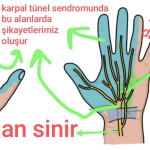 karpal tünel sendromunda median sinirin sıkıştığı yer