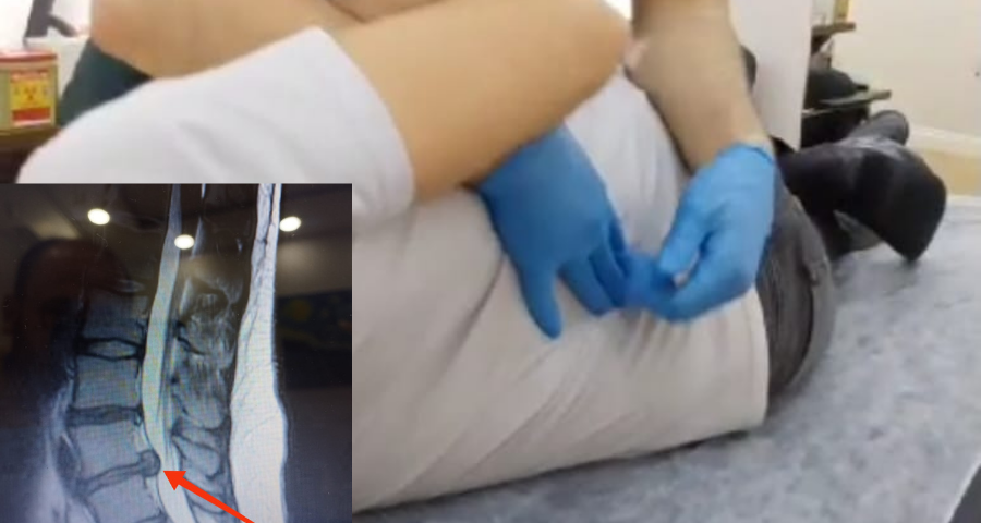 manuel terapi ile bel fıtığı tedavisi