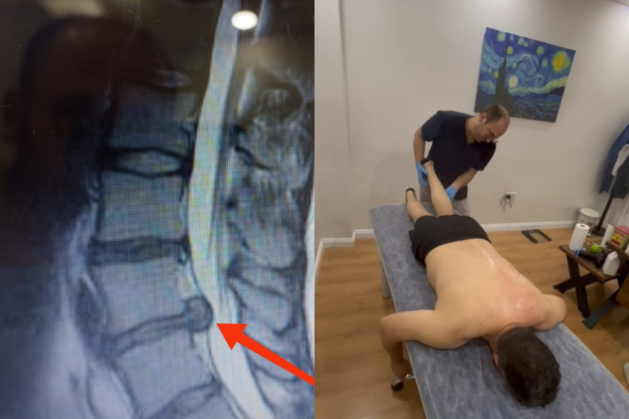 Ameliyatsız bel fıtığı tedavisinde bacağa vuran ağrı Bacağa vuran ağrı , uyuşma ve karıncalanma tedavisi