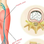 Siyatik sinir Siyatik Tedavisi Bakırköy Siyatik tedavisi sinirin sıkıştığı yere göre belirliyoruz Siyatik tedavisi manuel terapi ve doğru egzersiz ile olur