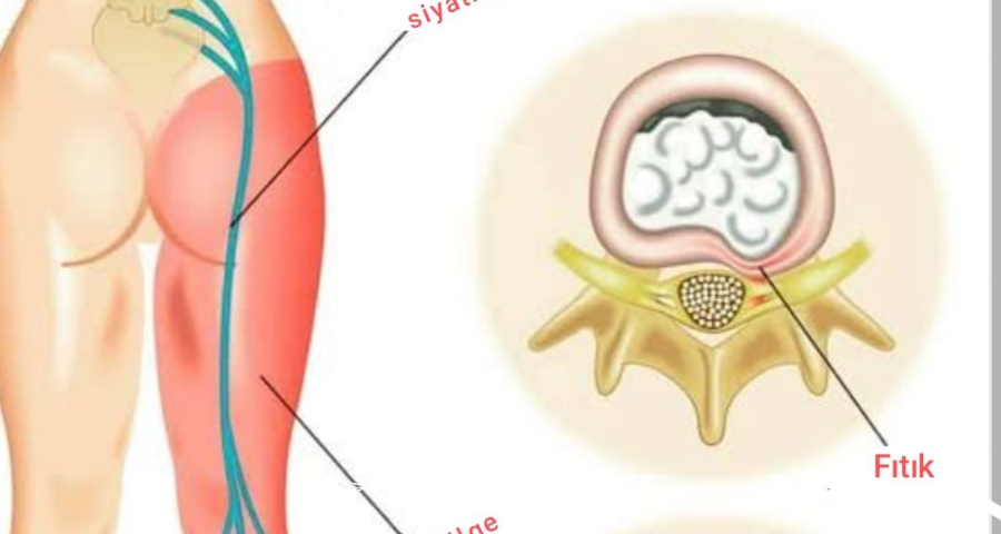 Siyatik sinir Siyatik Tedavisi Bakırköy Siyatik tedavisi sinirin sıkıştığı yere göre belirliyoruz Siyatik tedavisi manuel terapi ve doğru egzersiz ile olur