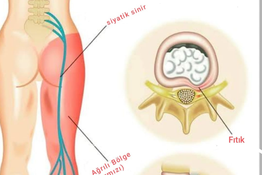 Siyatik sinir Siyatik Tedavisi Bakırköy Siyatik tedavisi sinirin sıkıştığı yere göre belirliyoruz Siyatik tedavisi manuel terapi ve doğru egzersiz ile olur