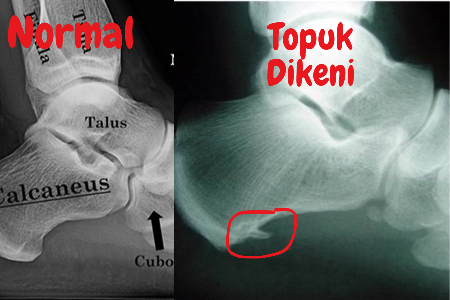 Topuk dikeni tedavisi , Topuk dikeni resmi